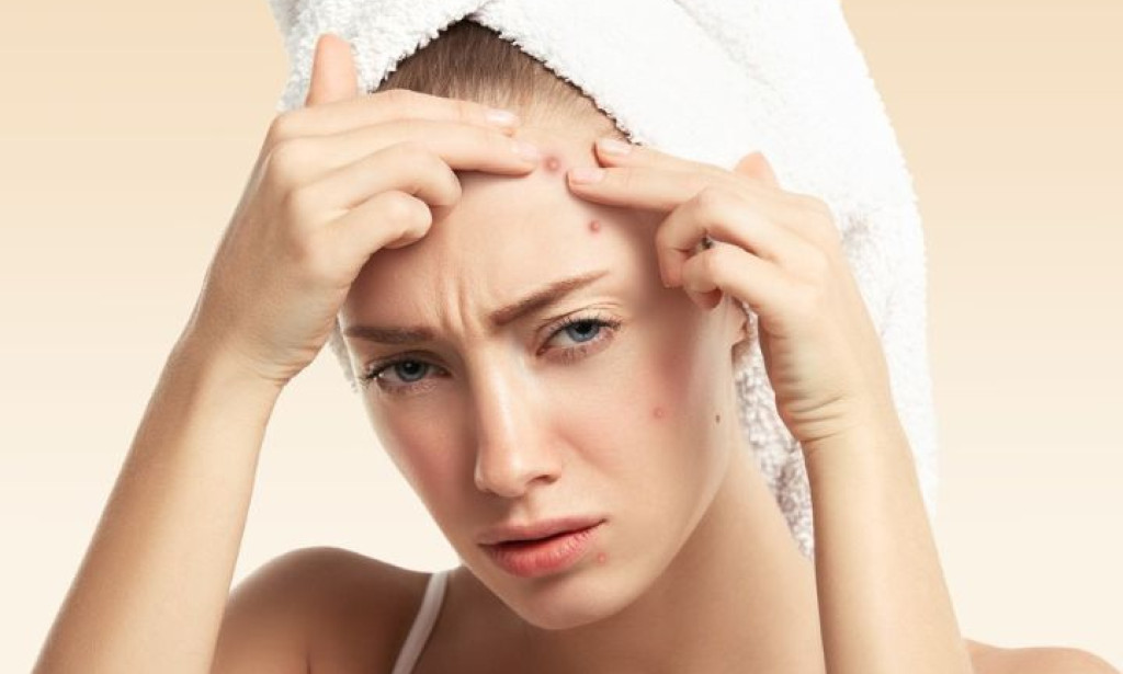 Does Monsoon Cause Acne?