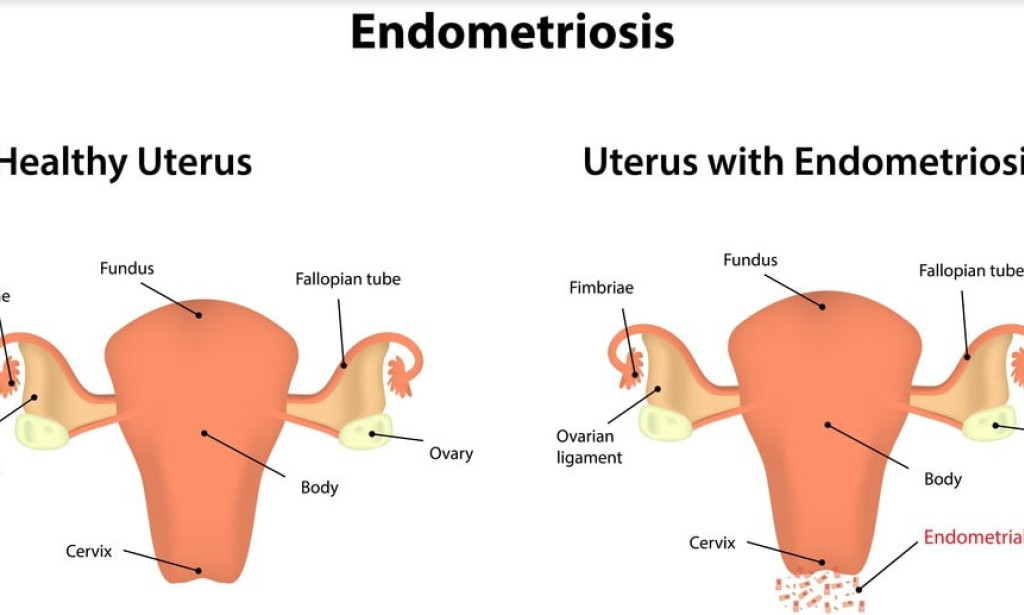 Treatment for Endometriosis: Holistic and Effective Care in Delhi