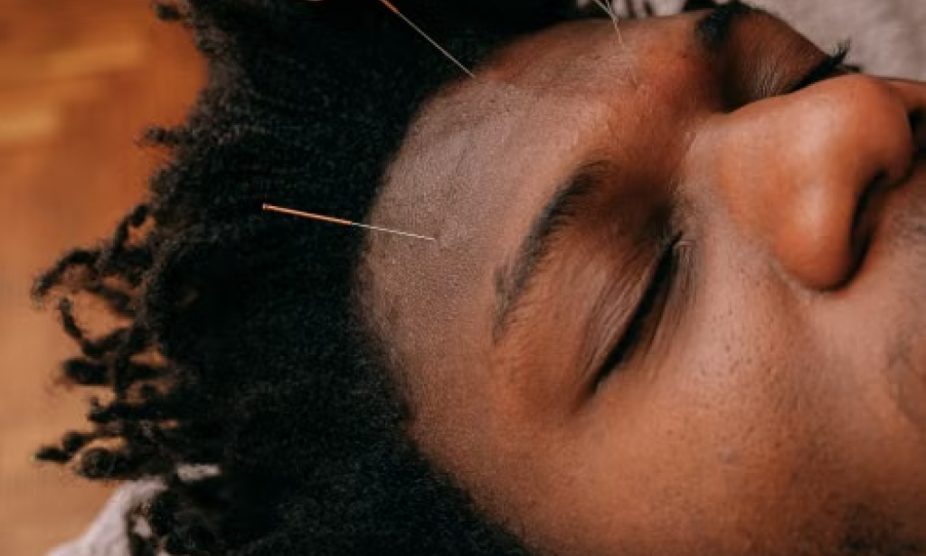 Beyond the Needle: What 2026 Research Reveals About Acupuncture’s Role in the Future of Pain Management